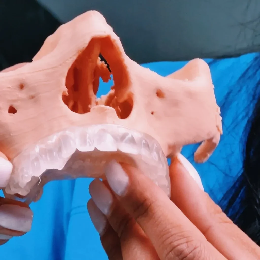 Costo impianti dentali a Barletta